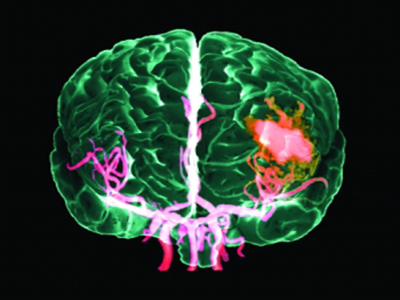 腦出血“征兆”大點兵!