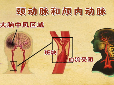 頸動脈狹窄引發卒中?