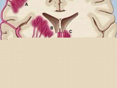 該如何預防中風我來告訴你