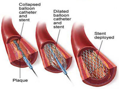 什麼是腦血管病?