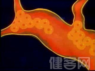 自我判斷高血脂的方法是什麼