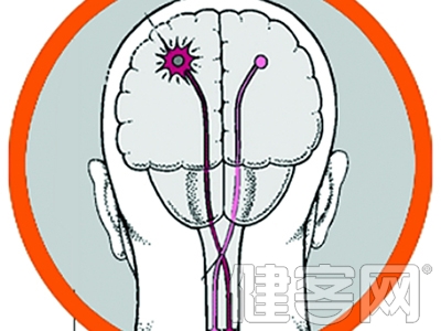 當心腦卒中&ldquo;逆襲&rdquo;年輕人
