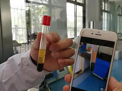 大爺愛吃油膩食物導致高血脂致&ldquo;牛奶血&rdquo;