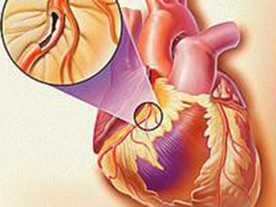&ldquo;心肌梗塞&rdquo;發生時如何自救？