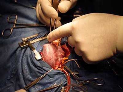 出現心肌梗塞之後早期有什麼症狀