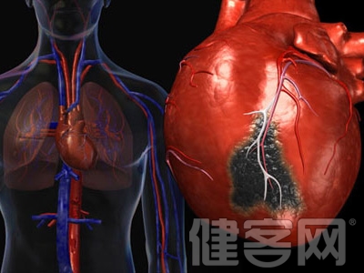 心梗不可怕&ldquo;防虎&rdquo;勝於&ldquo;打虎&rdquo;