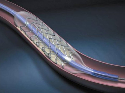 七旬大娘突然&ldquo;癡呆&rdquo;&ldquo;垃圾&rdquo;堵頸動脈近90%