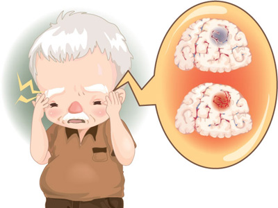 中風以後才知道，原來房顫是&ldquo;真凶！