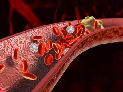 &ldquo;世界血栓日&rdquo;來了，血栓是最隱蔽的殺手