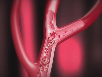 &ldquo;世界血栓日&rdquo;來了，血栓是最隱蔽的殺手