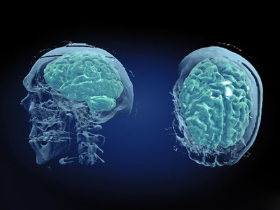 腦血管病呈現年輕化趨勢 &ldquo;頭&rdquo;等大事切莫忽視