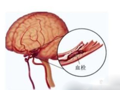 感冒硬扛了一周竟腦梗 醫生：年輕女性容易&ldquo;中招&rdquo;