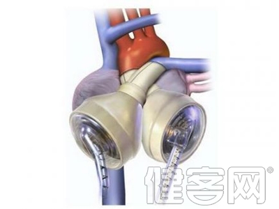 忽視10年的高血壓險致命 &ldquo;人工心髒&rdquo;助脫險