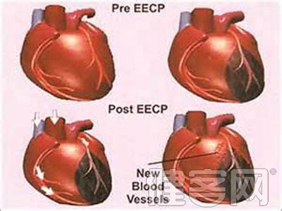 哪些瓣膜病可以進行置換手術