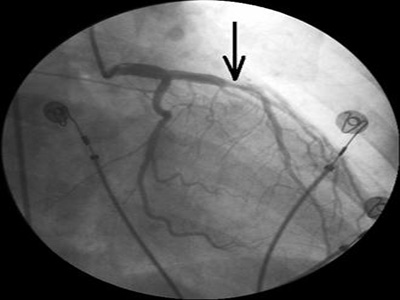 微創血腫清除術治療高血壓腦出血