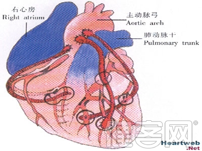 人工心髒移植成功 世界首例 能&ldquo;活&rdquo;5年