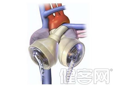 &ldquo;火箭心&rdquo;將成心衰患者福音