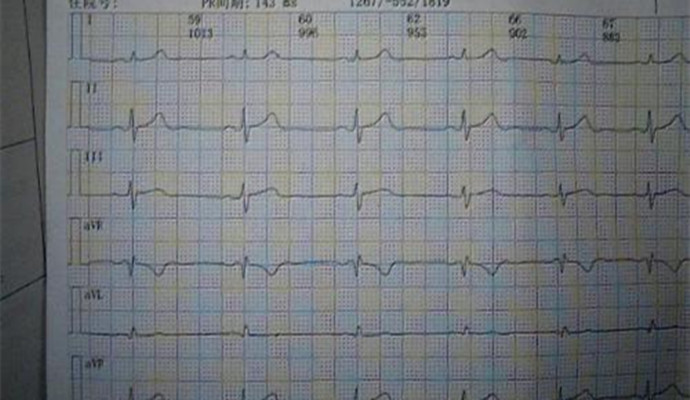 冠心病的早期症狀，了解了解！！！