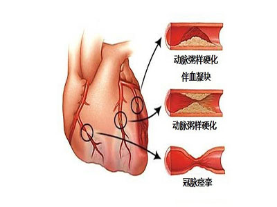 警惕潛伏在身體裡的心血管病&ldquo;殺手&rdquo;