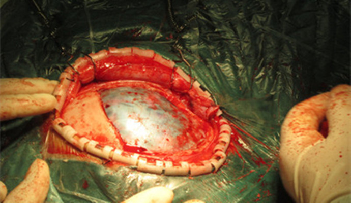 如何預防&ldquo;腦出血&rdquo;？