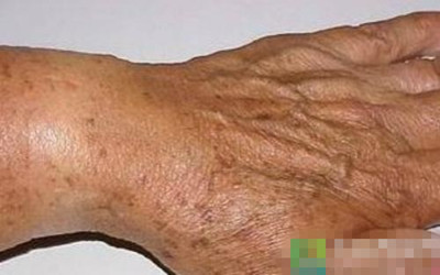 如果你有這五種症狀，可以考慮一下&ldquo;高血脂&rdquo;！