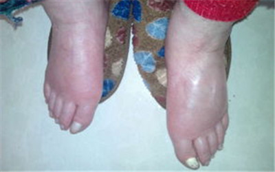 老年人腳&ldquo;長大&rdquo;？要警惕！