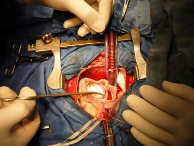 心髒手術：年齡不再是&ldquo;絕對禁區&rdquo;