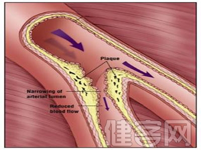 心血管內科介入治療的護理