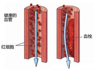 血管最怕&ldquo;堵&rdquo; 少熬夜多愛護