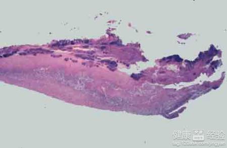 亞急性細菌性心內膜炎的症狀