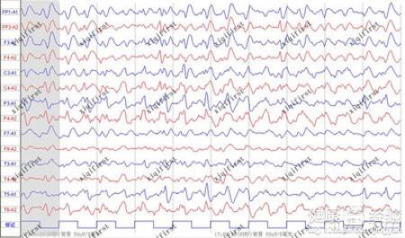 意識障礙如何檢查？