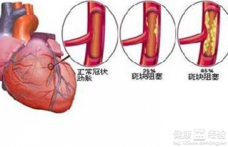 中醫怎麼治冠心病