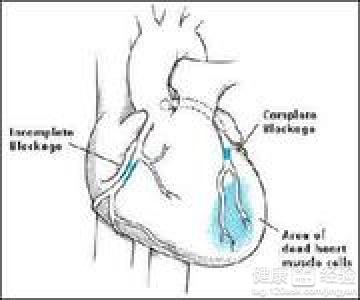 冠心病患者日常注意事項