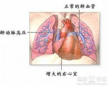梗阻性肥厚形心肌病中藥可以治療嗎