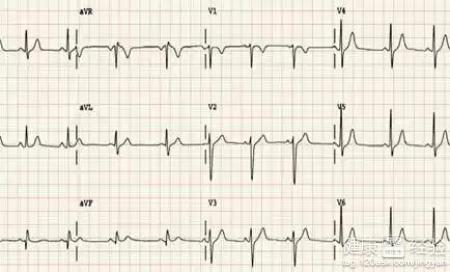 心肌炎應該吃什麼要？