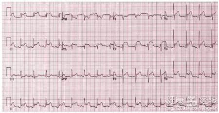 心絞痛的治療與飲食