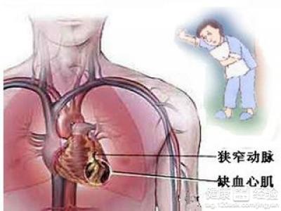 吃什麼預防心絞痛