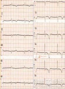 詳述心絞痛的症狀及治療