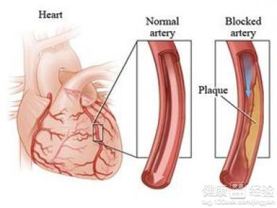 心絞痛嚴不嚴重