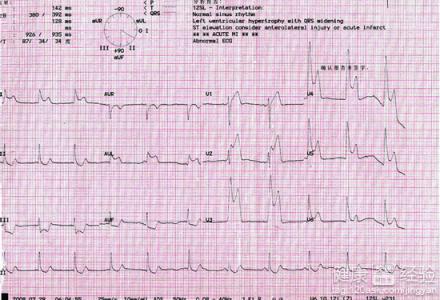 變異性心絞痛的心電圖是怎樣的