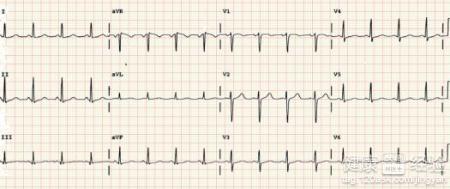 心律失常病人要注意的細節很廣泛