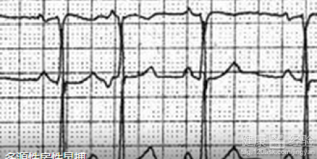 心律失常吃什麼藥安全