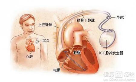 冠心病嗎和心律失常怎樣區分
