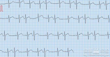 什麼是室上性心律失常