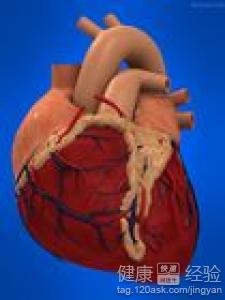 什麼是預激綜合征