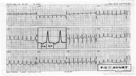 陣發性室上性心動過速怎麼辦？！