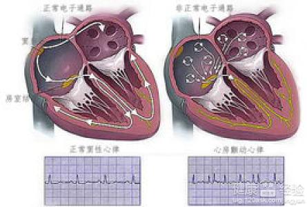 心率失常患者的飲食處理原則