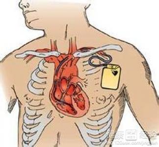 心髒早搏射頻消融的成功率有多高