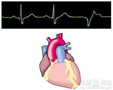 早搏應該怎樣治療可以控制復發