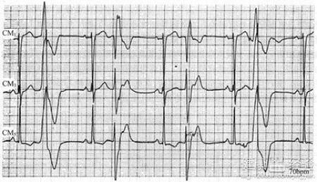 室性早搏可以服用什麼藥